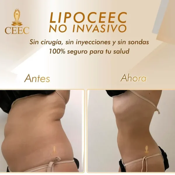 LipoCEEC