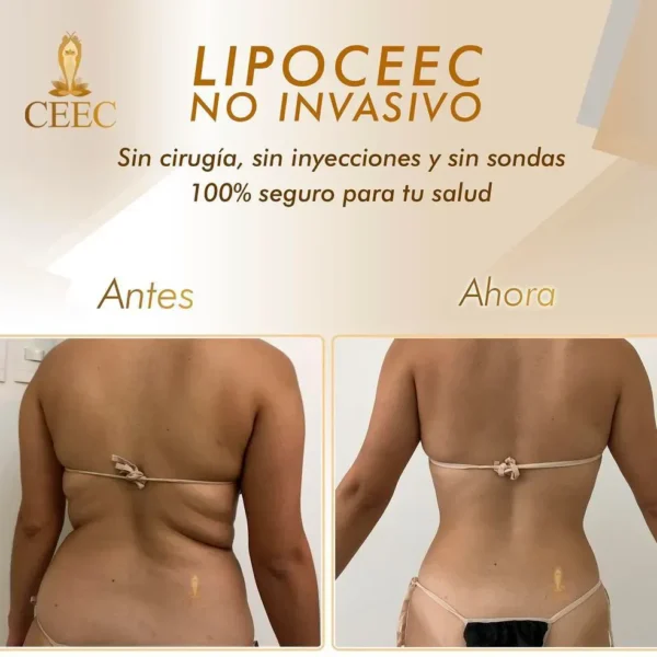 LipoCEEC
