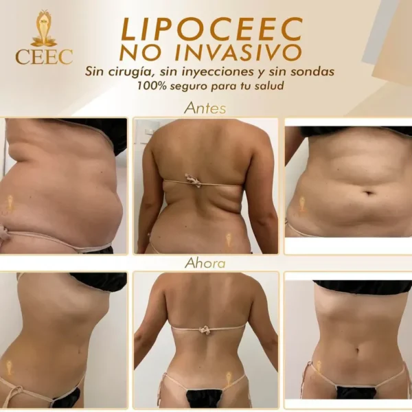 LipoCEEC